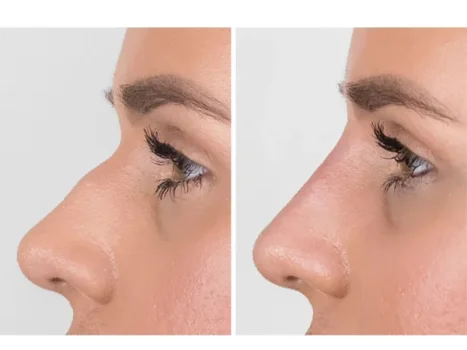 هر آنچه پیش از تزریق فیلر بینی باید بدانید